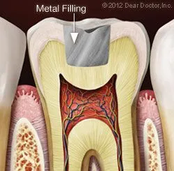 White Fillings