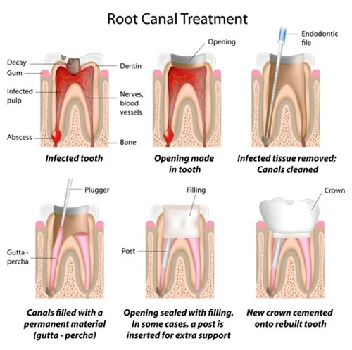 Root Canal Therap 