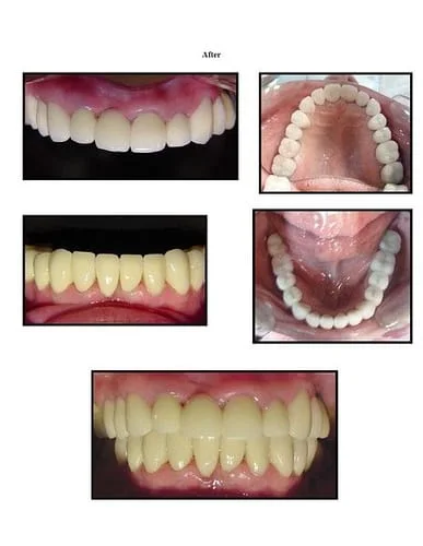 Full Mouth Reconstruction 2