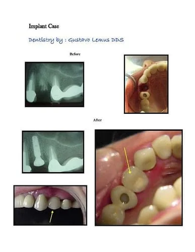 Immediate Implant Cases 1 