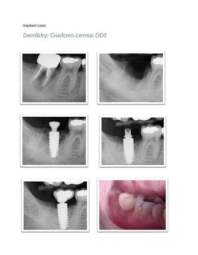 Immediate Implant Cases 2