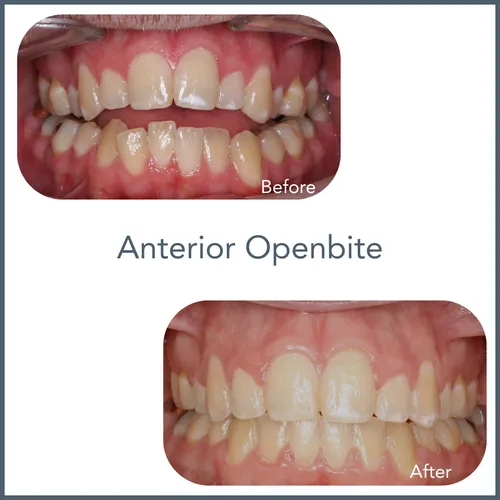 annterior.openbite