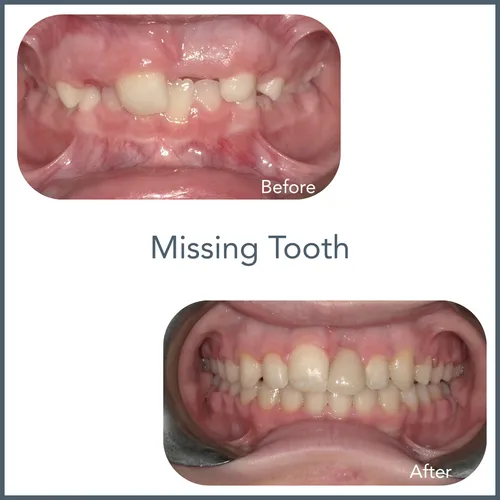 missing.tooth