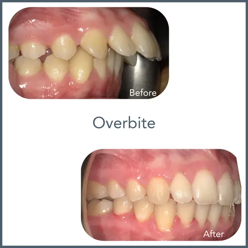 overbite