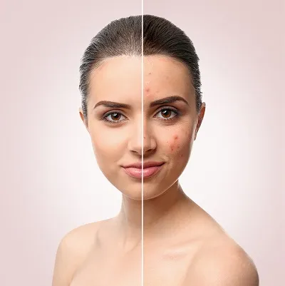 Acne Treatments in Savannah, GA