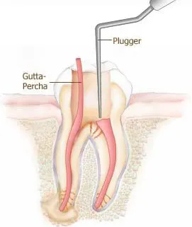 Lehi, UT Root Canals procedure