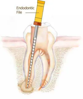 Root Canals procedure diagram Lehi, UT