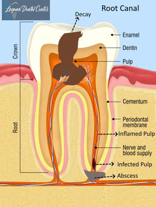 root canal