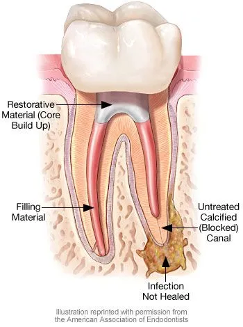 rootcanal_pic.jpg