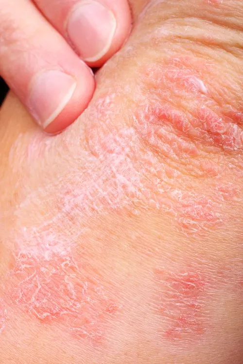 Psoriasis in Boise, ID