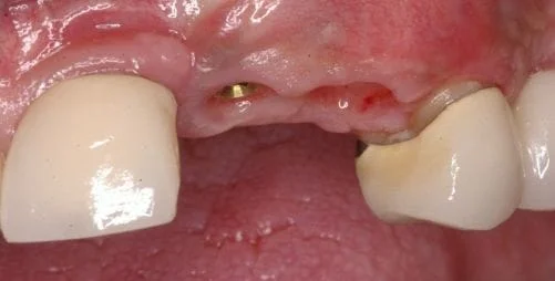 Dental Implant Before Crown