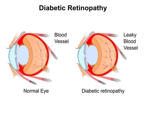 Diabetic Eye Diagram