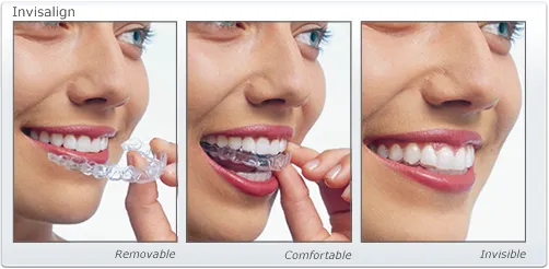 Invisalign Image