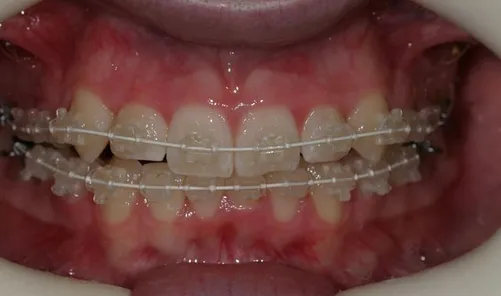 crowdedteethbraces.jpg - large