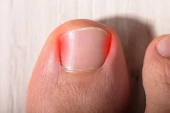 Ingrown Toenails in Marietta, GA