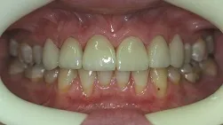 close up of woman's mouth showing teeth after new dental veneers Cumberland Park, SA dentist