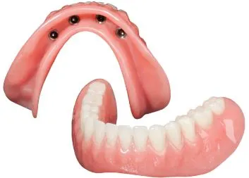 Implant supported Denture image Fairfield Bridgeport, CT