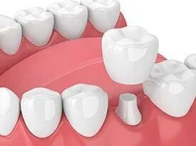 3D illustration of teeth in mouth, dental crown being placed on tooth, dentist Greenacres, FL cosmetic dentistry