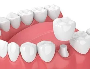 illustration of teeth in mouth, crown being placed over tooth, dental crowns Decatur, IL dentist