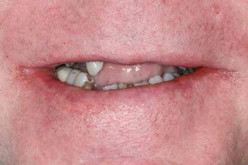 Smile dental trauma pre-treatment