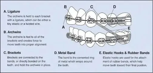diagram identifying names and descriptions of pieces of metal braces on teeth. braces Milford, MI orthodontist