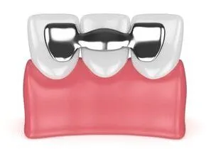 illustration of Maryland style dental bridge on teeth, dentist Melrose, MA dental bridges