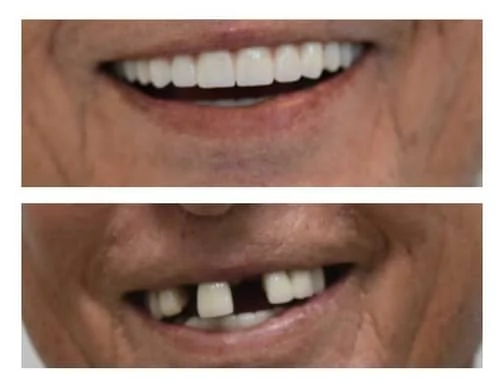 before and after image of man's mouth with missing teeth, then replacing teeth with dental implants Honolulu, HI