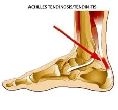 Achilles_Tendonitis.jpg