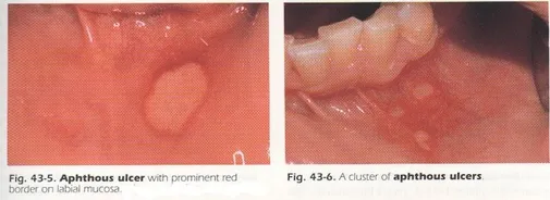 cold sore inside cheek