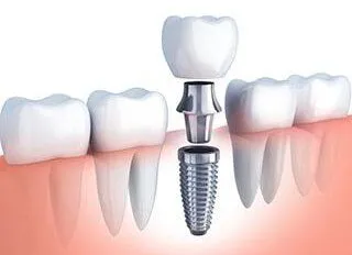 illustration of row of teeth in gums, dental implant parts being assembled to replace single tooth, dental implants Decatur, IL dentist
