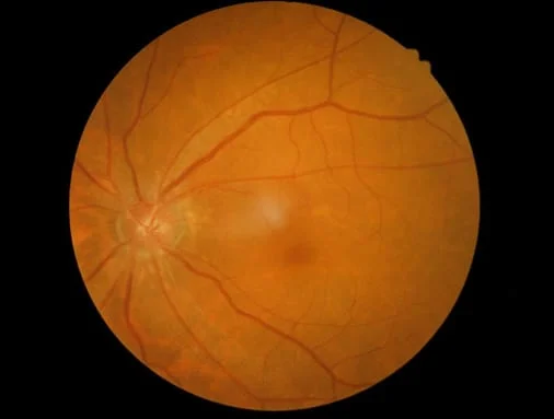 Illustration of diabetic retina
