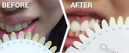 teeth whitening - before and after 