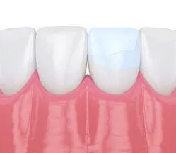 illustration of row of teeth, dental bonding on one tooth fixing crack, dentist Boulder, CO dental bonding and cosmetic dentistry