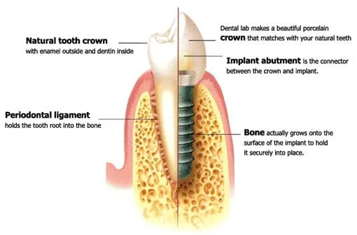  StraumannÂ® Dental Implants