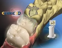 CEREC Same Day Crowns Baltimore, MD