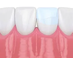 illustration of teeth, one with dental bonding repairing crack, cosmetic dentistry Old Bridge, NJ cosmetic dentist