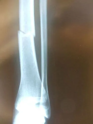 Diaphysis - Robert Sheinberg, DPM | Weston, FL Podiatrist