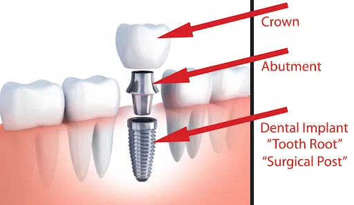 dental implants Edmond, OK