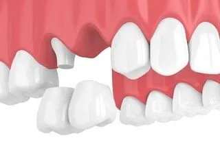 illustration of cantilever bridge being placed in mouth to replace tooth, dental bridges Melrose, MA dentist