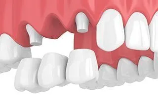 illustration of traditional dental bridge being placed over prepared abutment teeth, dental bridge Melrose, MA dentist