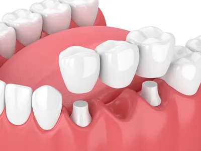 3D illustration of dental bridge with three crowns being placed over abutment teeth, cosmetic dentistry University City, MO dental bridges