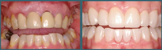 smile- before and after