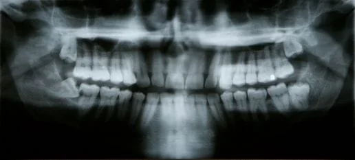 Impacted tooth x-ray