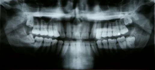 After impacted tooth