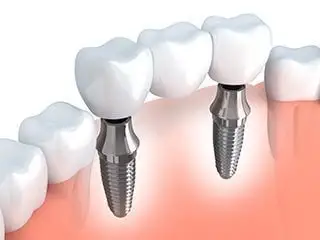 illustration of fixed dental bridge using dental implants, Salem, OR implant dentistry