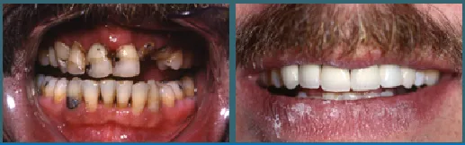 smile- before and after