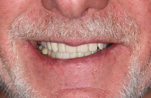 Dental trauma smile restored