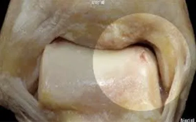 Osteochondral Lesion of the Talus