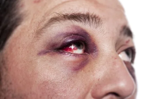 Eye injury on sports