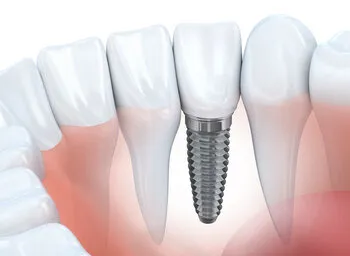 illustration of teeth and gums with dental implant embedded, dental implants Peachtree City, GA dentist